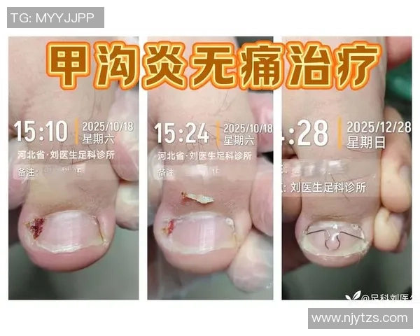 足球明星因甲沟炎困扰赛季表现专家解析病因与康复之道 足球明星因甲沟炎困扰赛季表现专家解析病因与康复之道